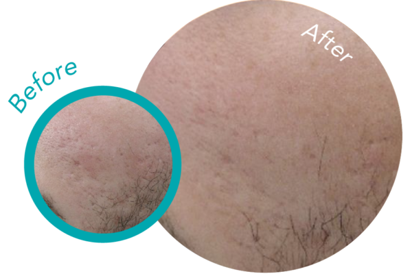 CUTERA Secret RF Before and After 3