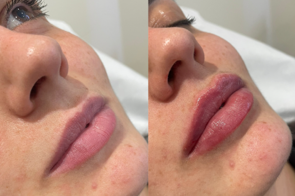 Lip Filler Before and After