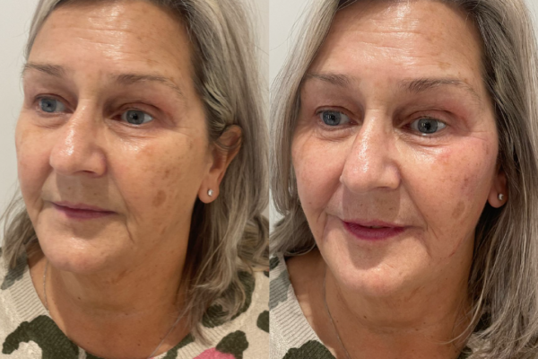 Botox and Dermal Fillers Before and After