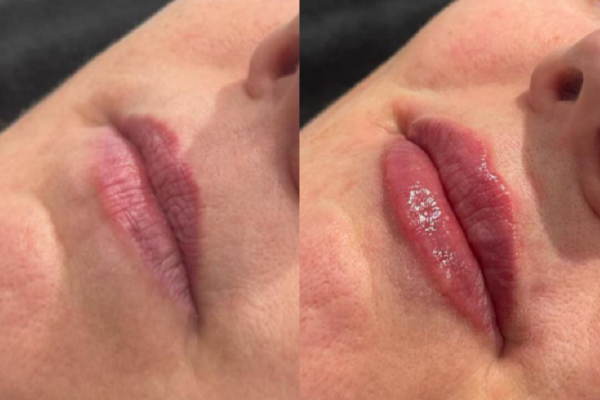 Lip Filler Before and After