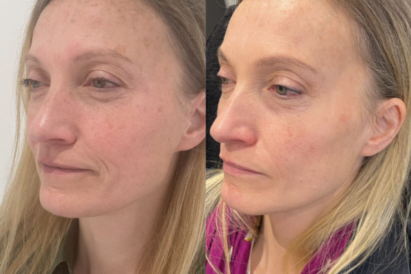 Prescription only skincare before and after