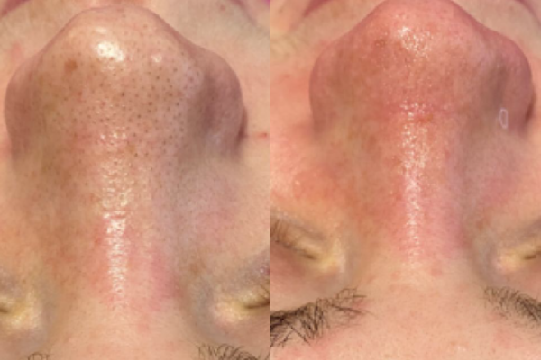 Hydrafacial Before and After
