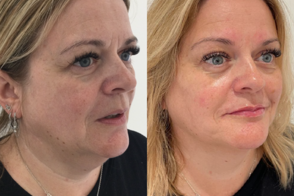 Dermal Fillers Before and After