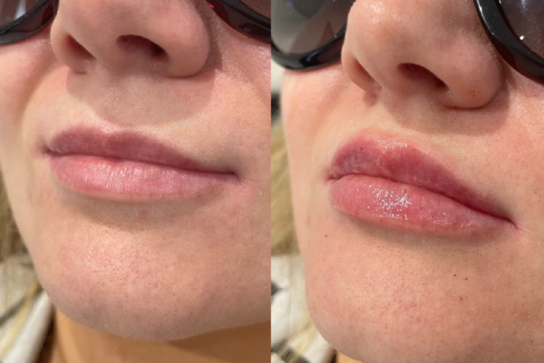 Lip Filler Before and After