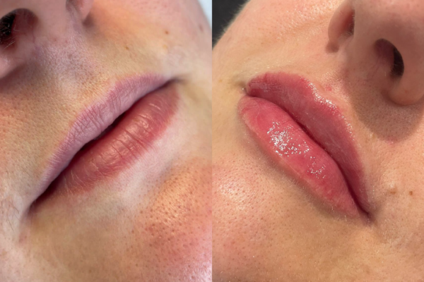 Lip Filler Before and After