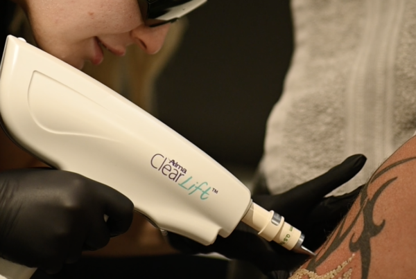 Tattoo Removal
